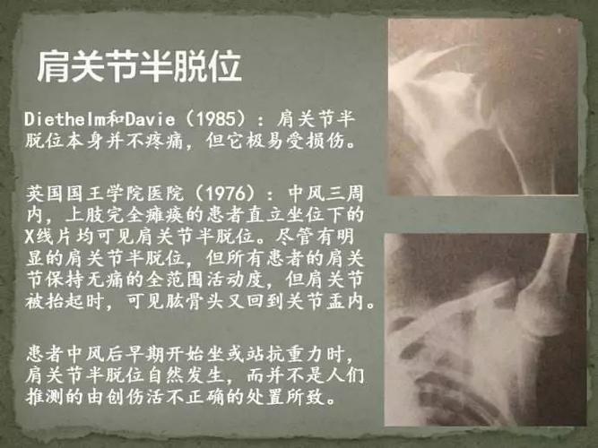 肩关节半脱位(又称不整齐肩)在偏瘫患者中很常见.