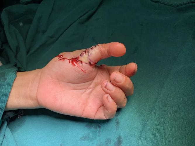 脚趾变手指,正兴手足外医生"移花接木"出奇招!