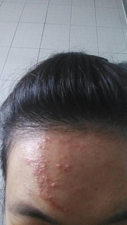 问:脸部突然红肿疼痛,起了一片小包,还带着脓,这是什么皮肤病?