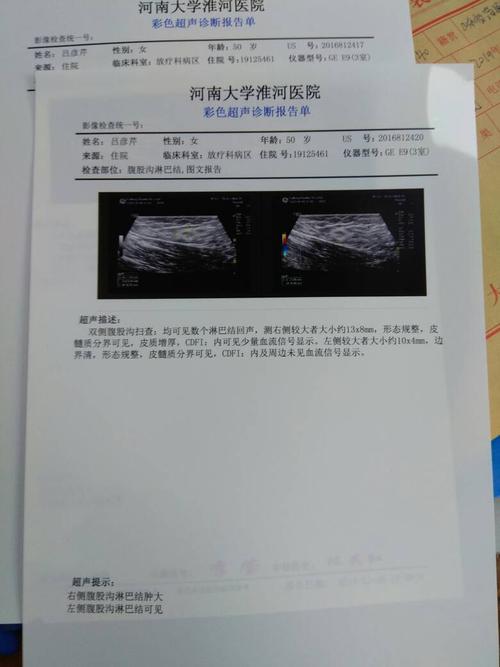 复查结果腹股沟有淋巴结,有事吗?