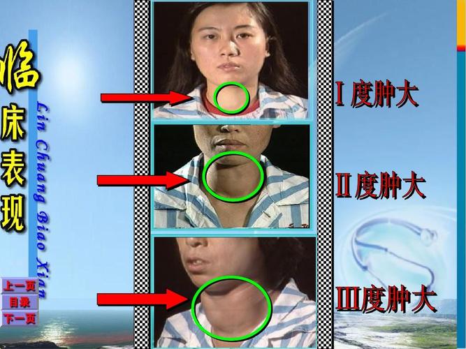 亚急性肉芽肿性甲状腺炎