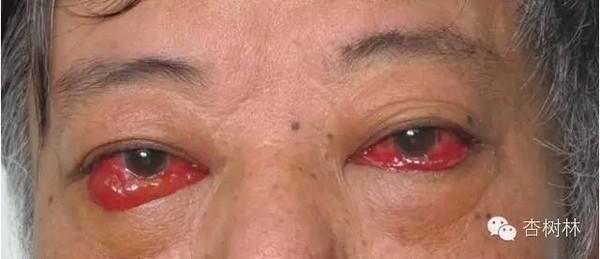 球结膜高度充血水肿原来可以这样治