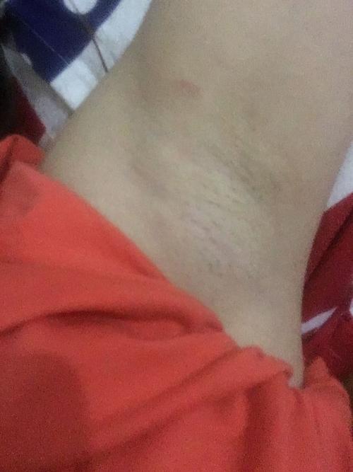 腋下长了个大包,医生说什么淋巴,没仔细听应该没事吧