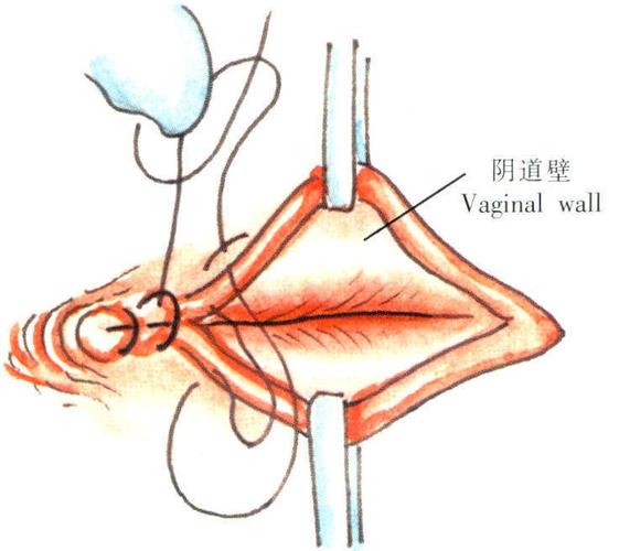 筋膜外扩大全子宫切除术