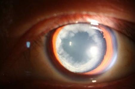 (3)急性青光眼急性青光眼并发性白内障在前囊下可见青光眼斑,斑点为