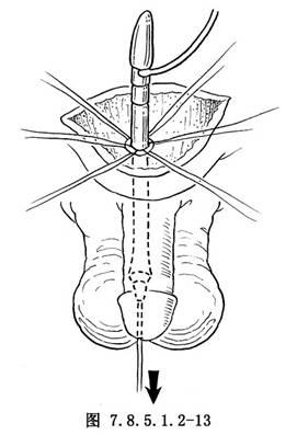 【面骨硅胶假体植入术】面骨硅胶假体植入术手术详细