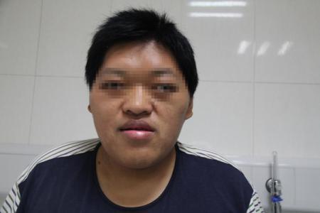 巨人症及肢端肥大症有哪些饮食禁忌 其治疗方法有哪些