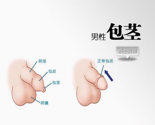 包茎手术的治疗介绍