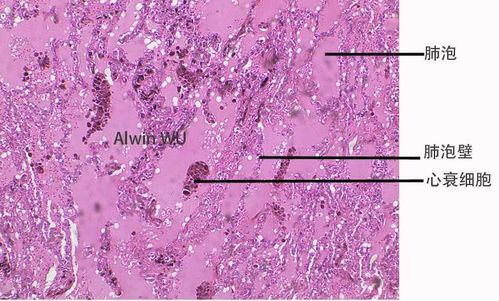 肺水肿病理:肺泡壁毛细血管扩张淤血,肺泡腔内可见大量水肿液和心衰