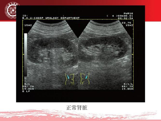 统疾病的超声诊断(山刚志)ppt