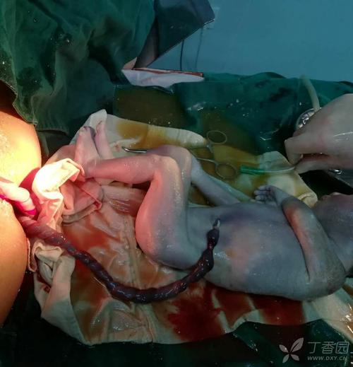 孕37 4周,死胎原因是什么?如何引产? [病例帖]