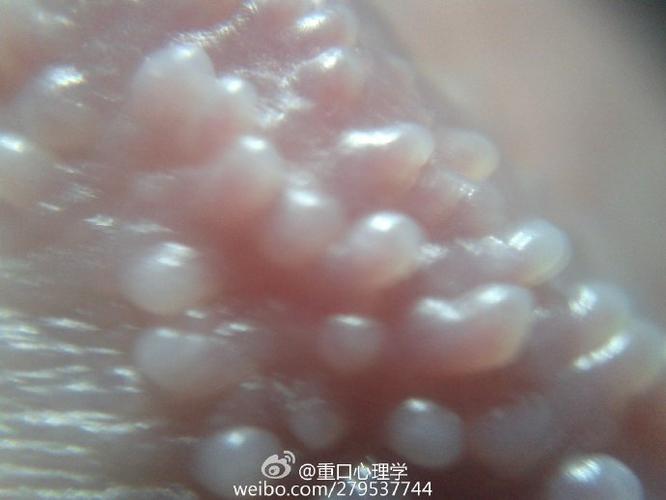 珍珠疹,很多人的私处都有,虽然无害但是影响美观,你们