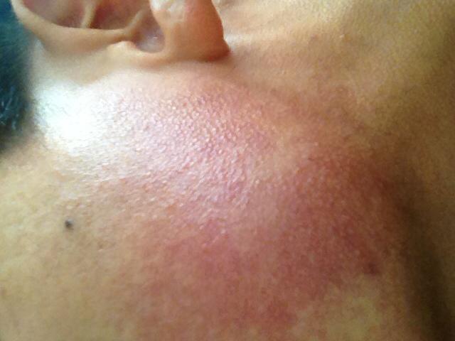 本人男,脸部两侧脸颊总是红的,一直红的,没紧张没运动