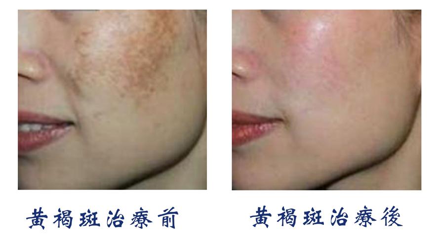 黄褐斑治疗效果