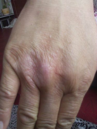 去医院看下皮肤科,皮肤科医生一看就知道是哪种皮肤病了,会对症治疗的