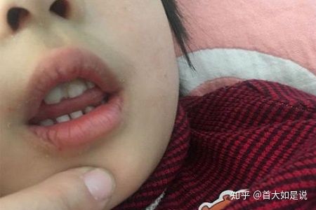 首大计成:腺样体面容出现前期有哪些表现