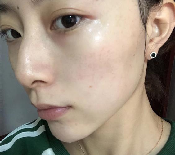 半个月啦,刚洗完脸拍的照片,素颜近看的话-皮秒-大众