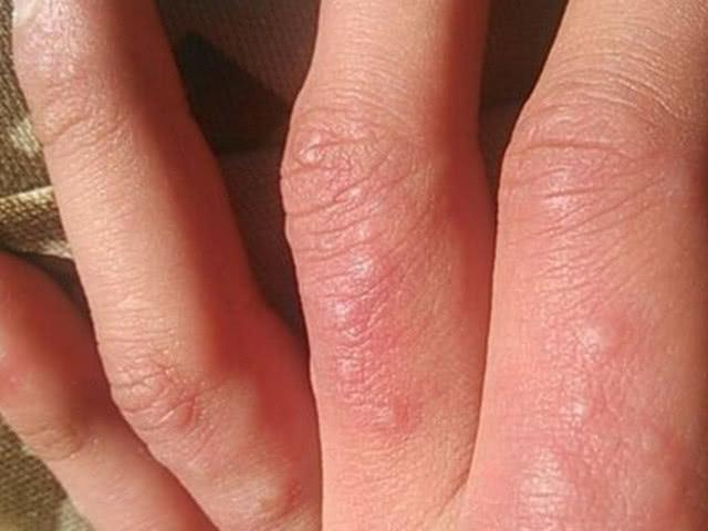 手上有湿疹该如何护理好?