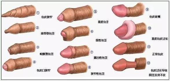 中山市人民医院小儿外科2021年寒假包皮手术开始预约