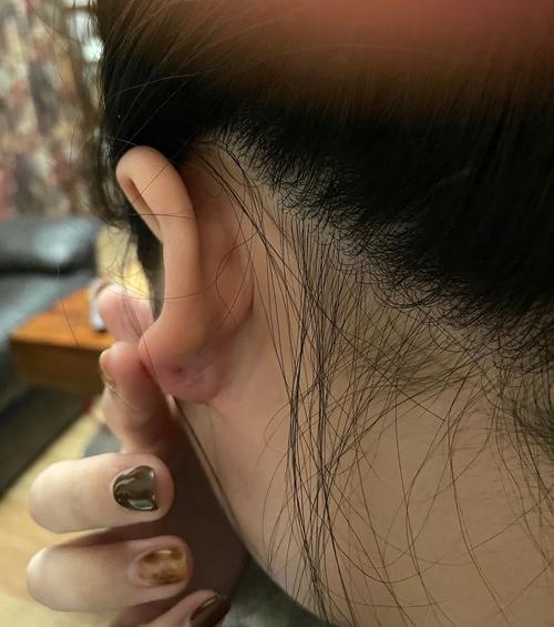 很多年的耳洞突然红肿疼痛怎么回事啊5555