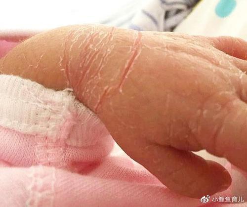 新生儿皮肤脱皮是怎么回事?