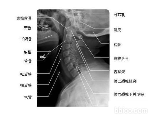 颈椎侧位 x线片(图片)(颈椎)