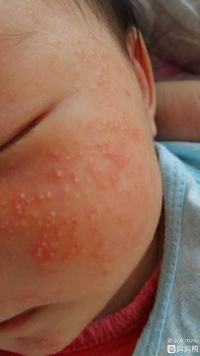 宝宝脸上有湿疹怎么办?抹了药膏也不管用.