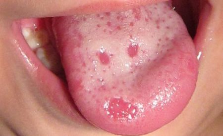 宝宝舌头出红斑,求解