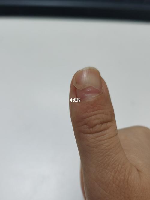 甲沟炎之后,新的指甲长出来了_医疗健康_医疗健康其他