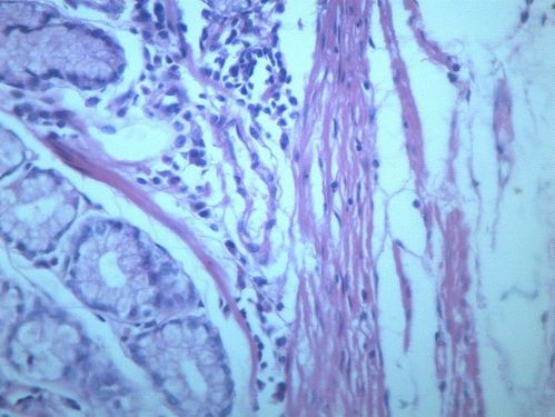 慢性萎缩性胃炎 显微切片图片