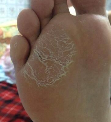 脚上出现这4种症状, 可能是"糖尿病足", 现在发现还不