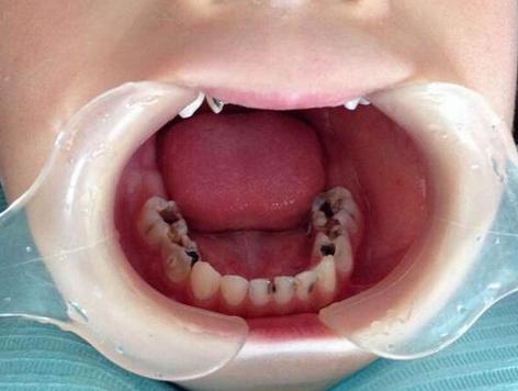 这篇关于儿童牙痛的文章,请一定收好