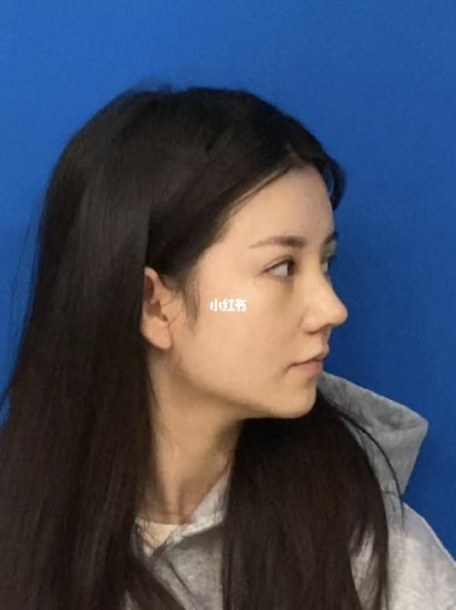 高挺略带小驼峰鼻 7天_鼻综合_美妆_医美整形
