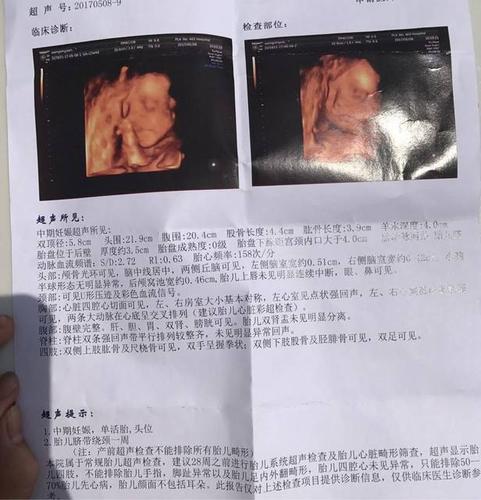 已生男宝的四维彩超单子,两次的四维彩超单,有会看男女的么,挺好奇的