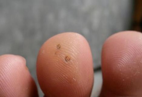 肉刺如何去除好?小肉刺竟藏大危害,希望你注意