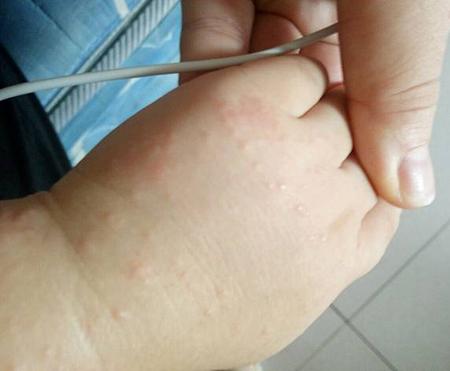 宝宝身上长疥疮了该怎么办