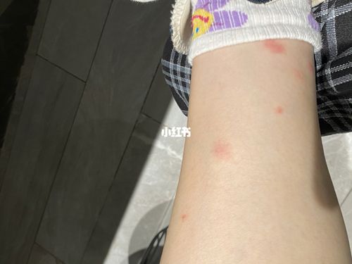 这是蚊子咬的还是螨虫咬的啊_螨虫_生活记录_接