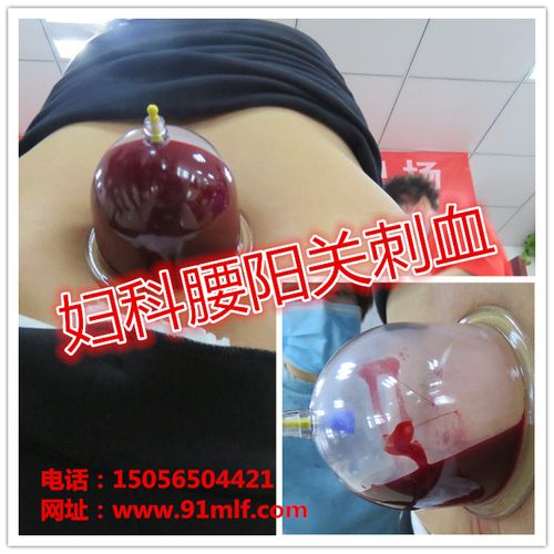 脉立方王氏刺血186期刺血班——来自阜阳的学员为追求