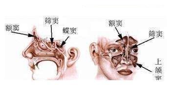 重庆弘医堂医院讲解鼻窦炎有哪些严重的危害