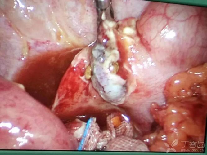 【案例分享】无法结扎的阑尾根部坏疽穿孔如何处理?