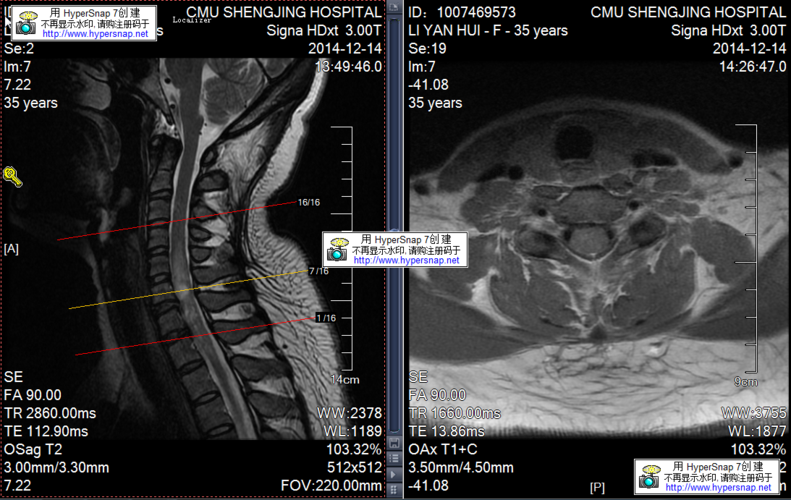 反复发作的脊髓脱髓鞘病变一例