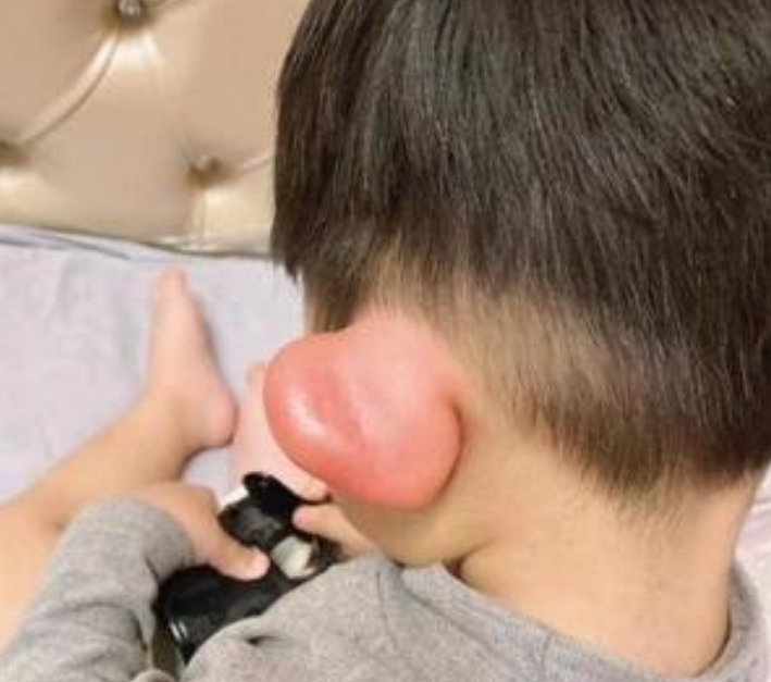 原创宝宝被蚊子咬成"大耳朵图图",又疼又痒还留疤,怎么处理最好?