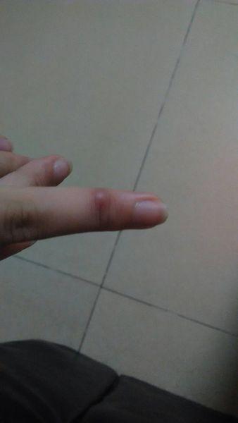 问:食指关节长肉瘤,几个月就这么大了
