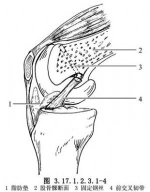 前交叉韧带断裂早期修补术