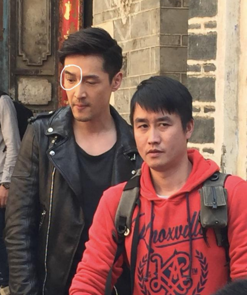 胡歌烫伤脸真实照吓坏网友毁容后患无穷