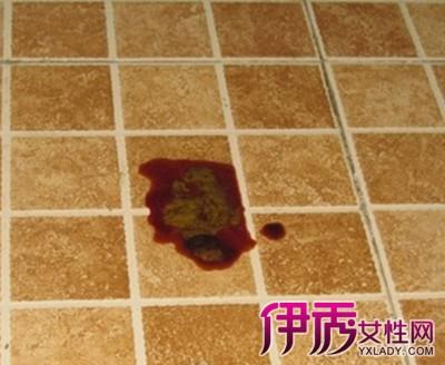 【图】直肠癌便血图片 直肠癌便血与痔疮有啥区别