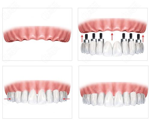 上海美呀植联口腔种植牙多少钱?多个品牌的价格表可参考
