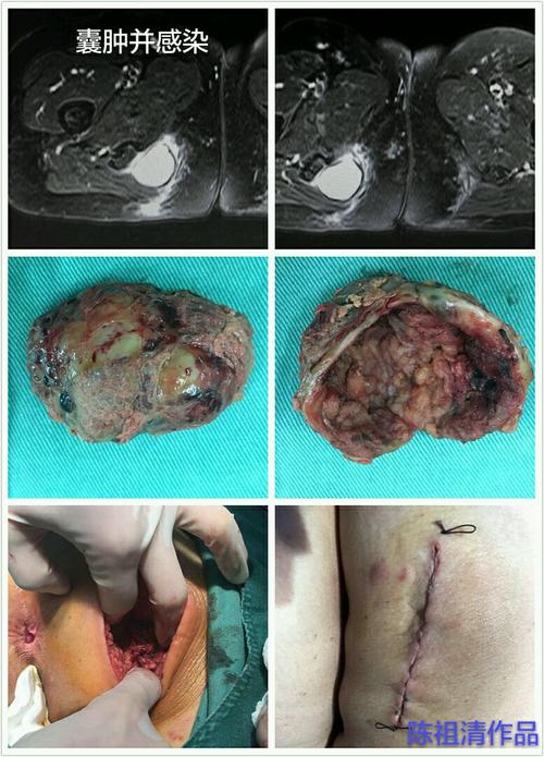 坐骨结节囊肿并感染