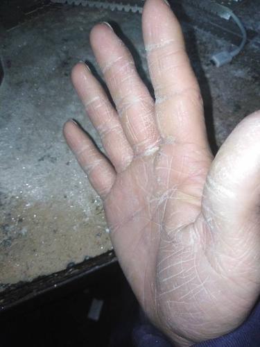 大家好,我的右手手掌发白,手上有裂痕,皮肤很硬,怎么回事