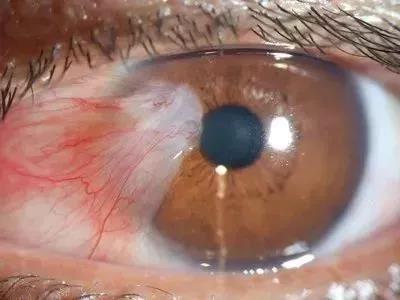 眼睛里长"息肉",要当心翼状胬肉!